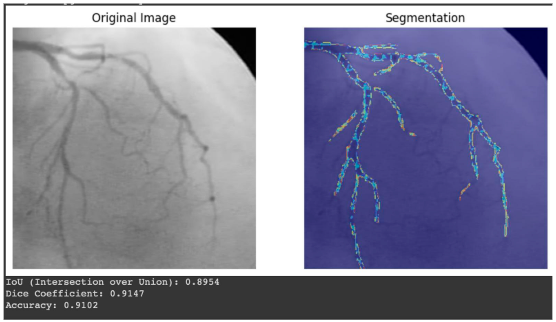 SegGPT in angiographic images